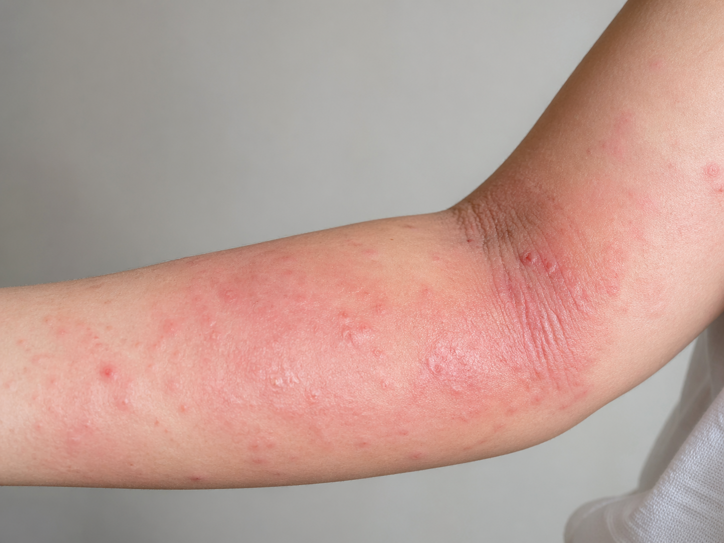 Homeopathy for Eczema: Natural Ways to Heal Skin From the Inside Out