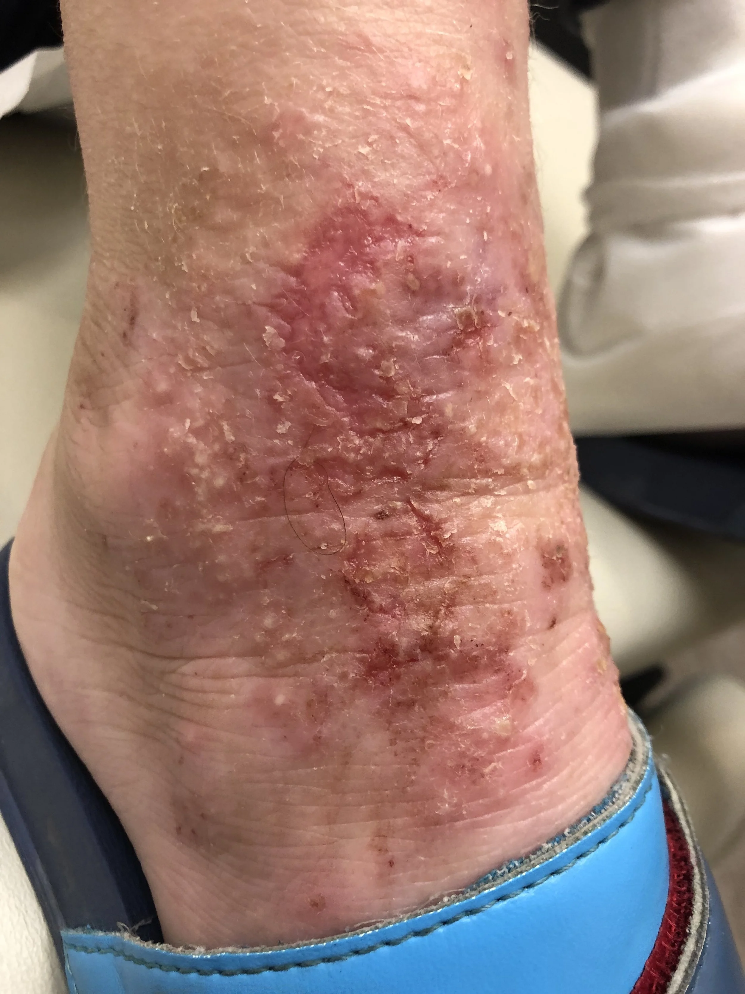 Homeopathy for MCAS and Eczema: Can Histamine Be Triggering Your Skin Flares?