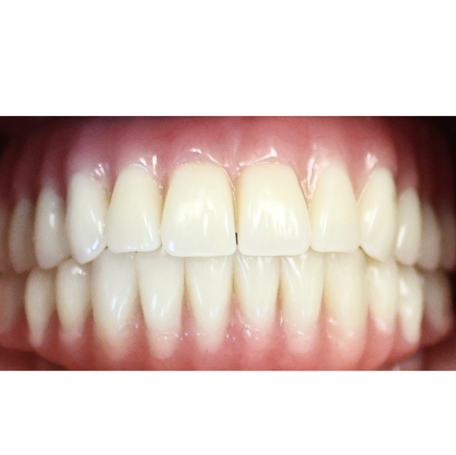 After Implant-supported dentures