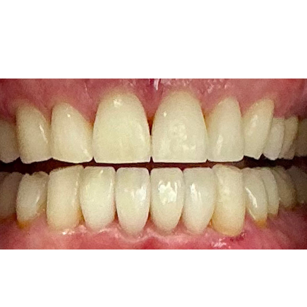 After Lower Veneer Treatment (6 Units)
