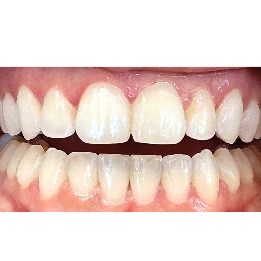 After Invisalign Treatment