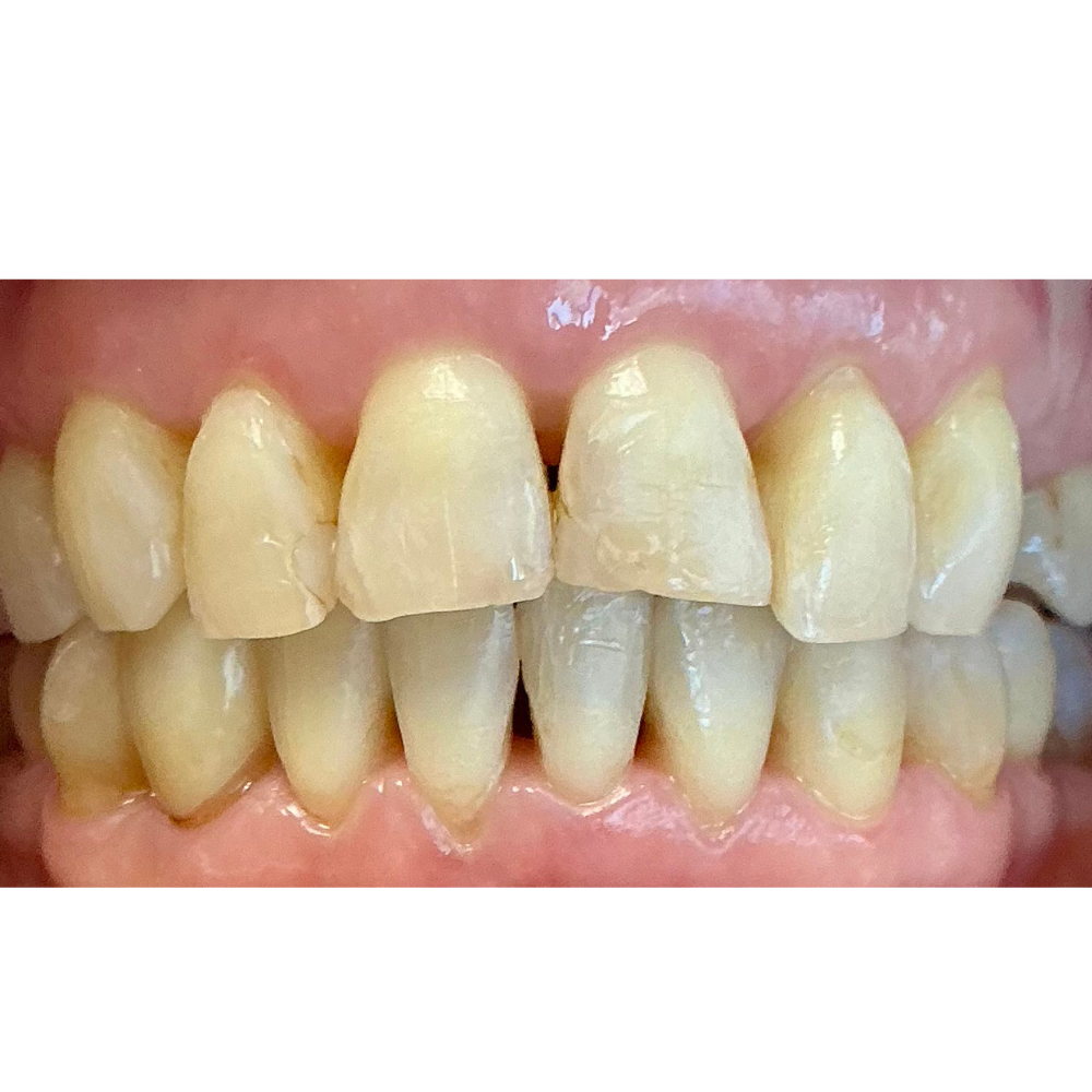 Before Composite Bonding (4 Units)