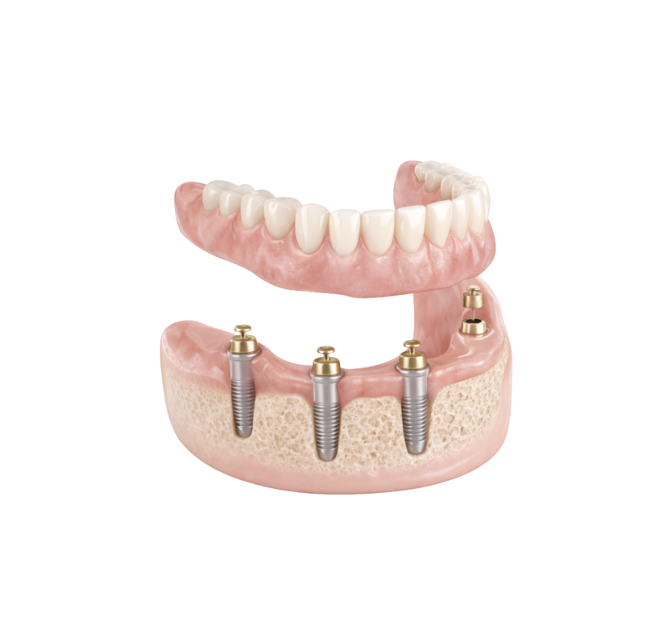 Implant-supported denture model