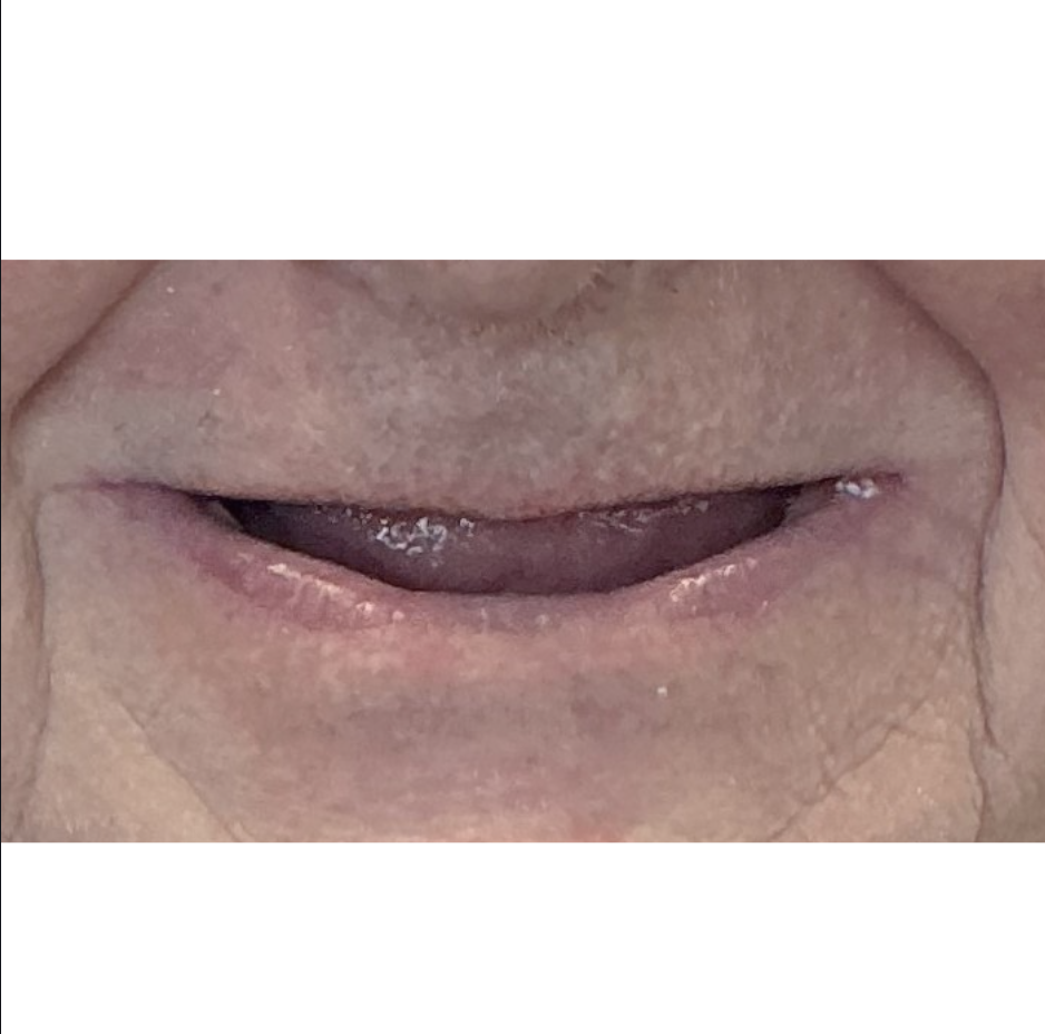 Before Implant-supported denture