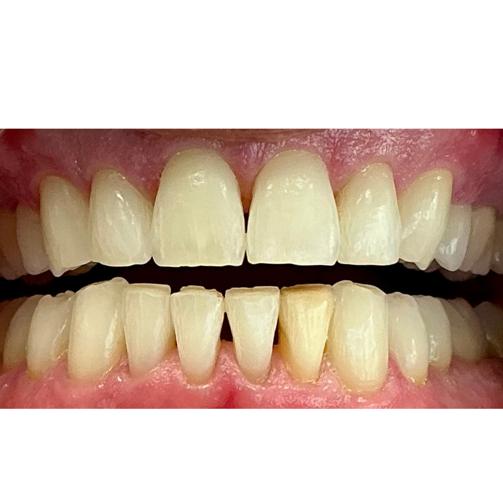 Before Lower Veneer Treatment (6 Units)