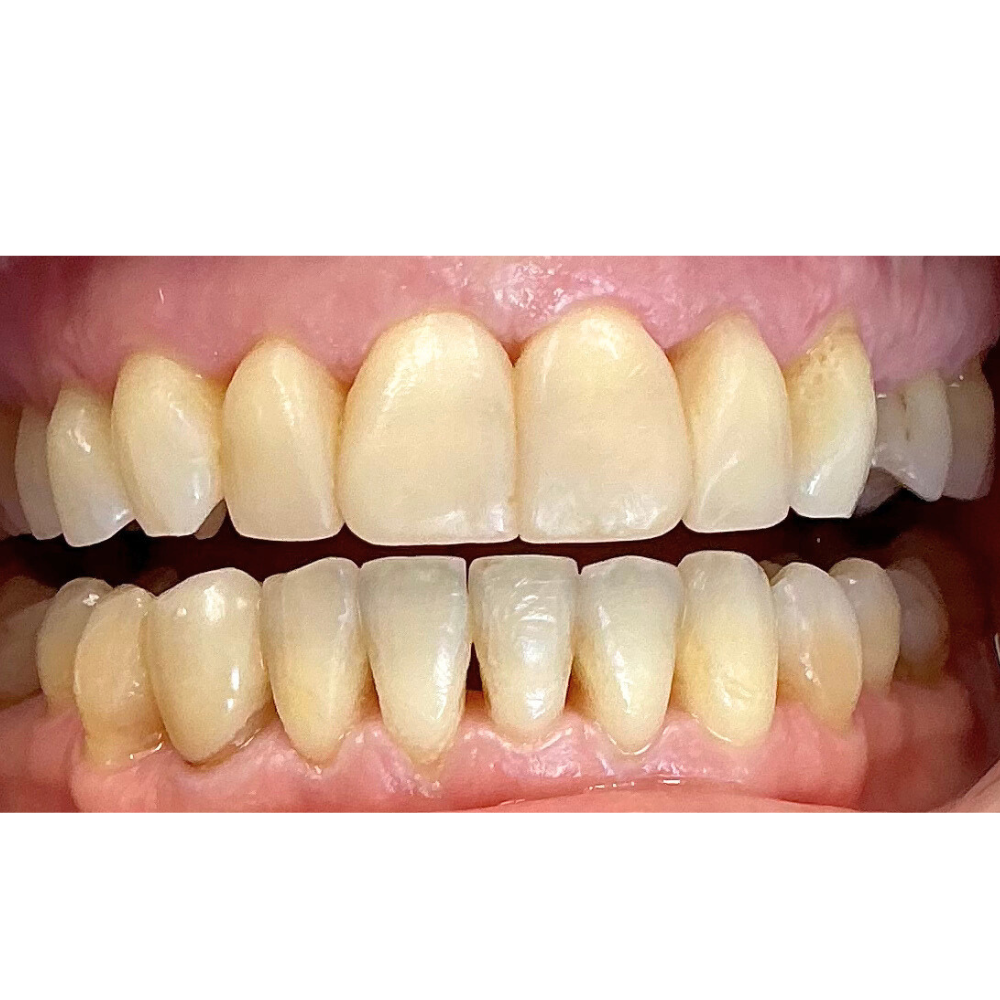 After Composite Bonding (4 Units)