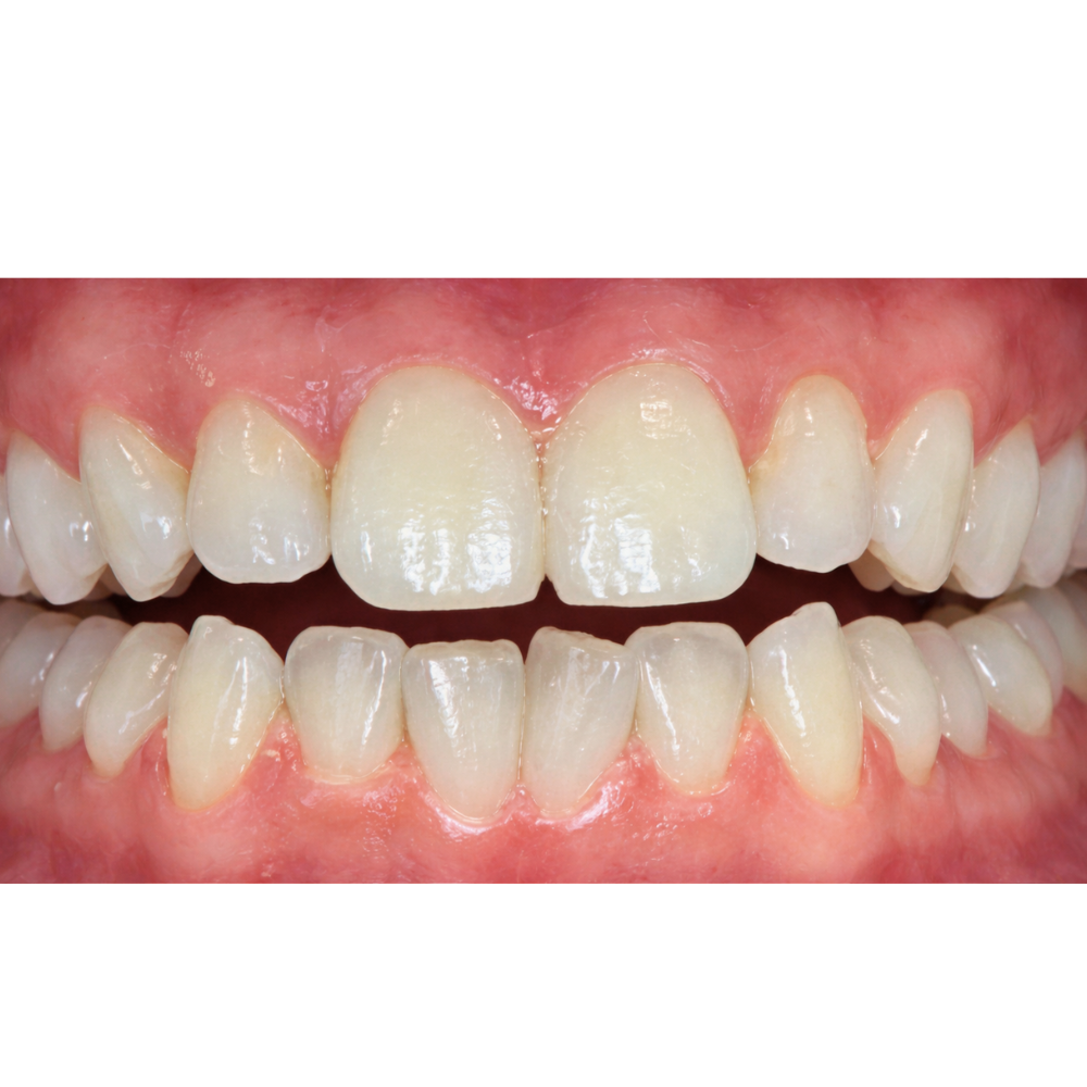 Before Invisalign Treatment