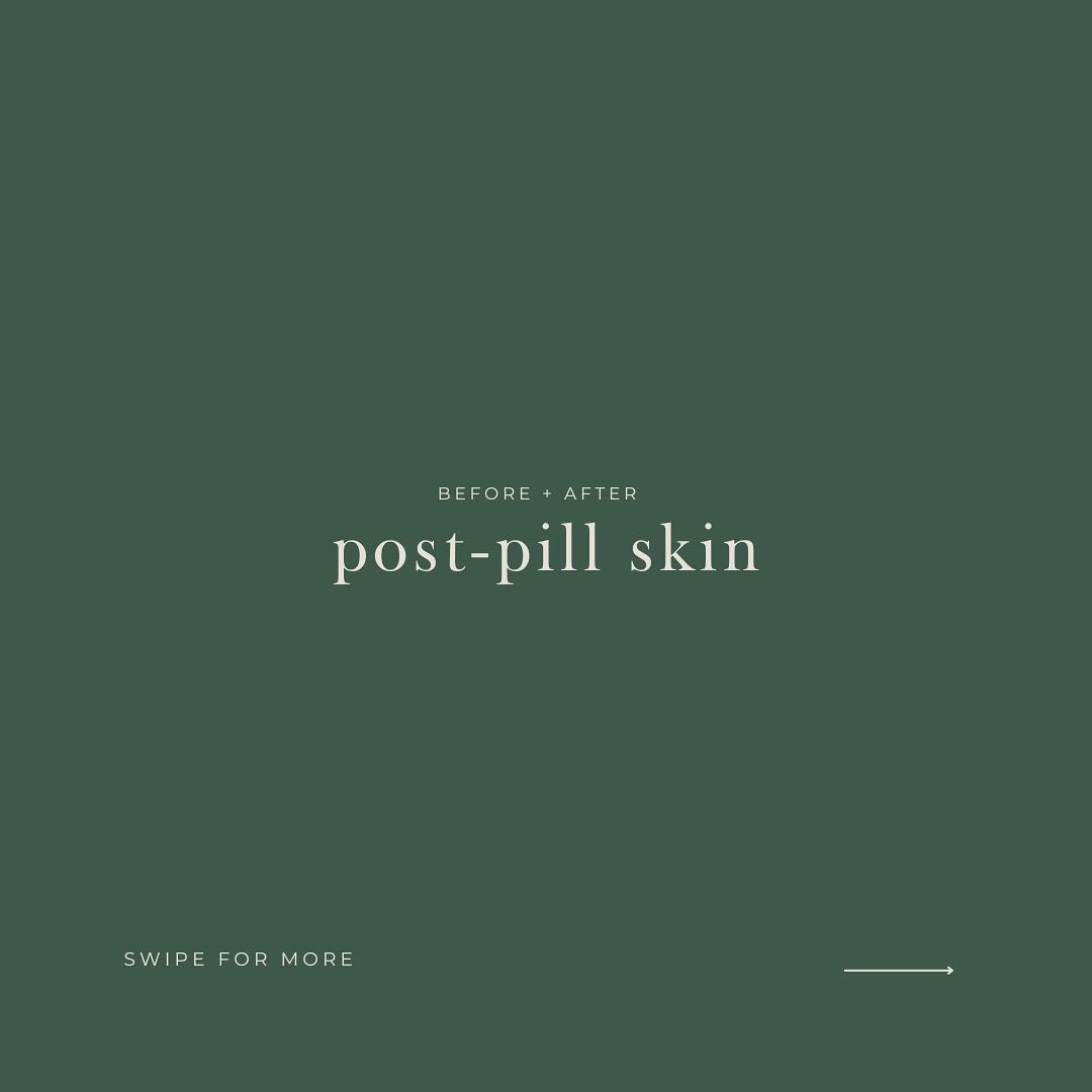 BEFORE &amp; AFTER: POST-PILL SKIN

OKAY, lots of you have been waiting for this one! Seems like perioral derm is an issue for many of you at one point or another so it took a little longer than planned as I wanted to put together a blog on this for 