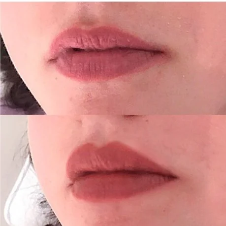 Lip Filler Client 8.jpg
