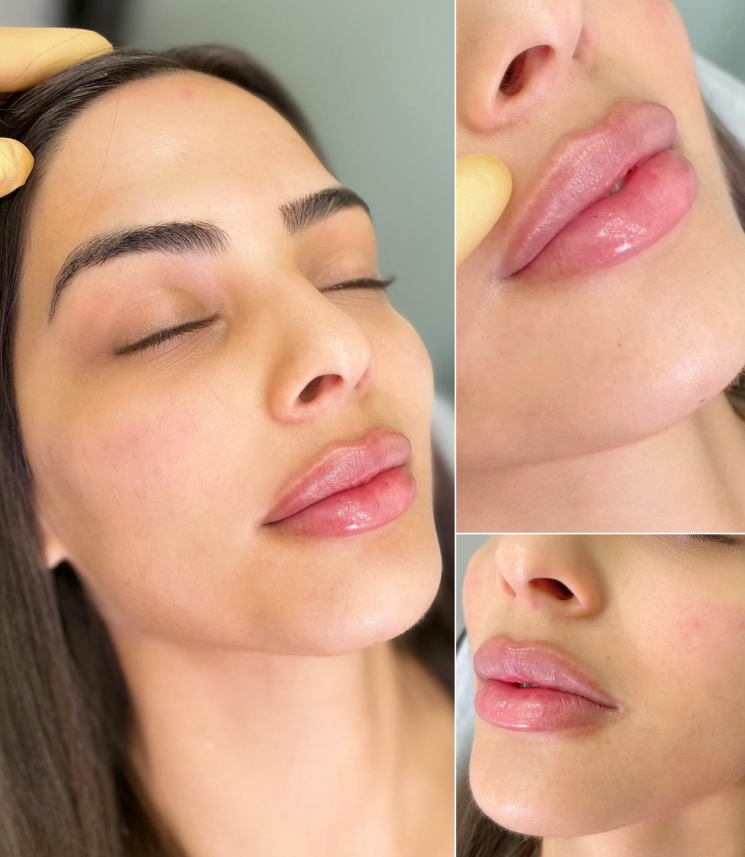 1mL Lip Filler