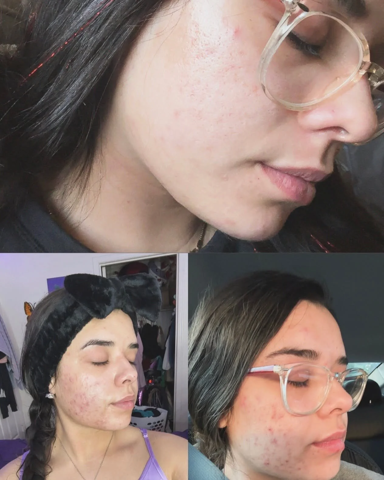 We love seeing our clients fall back in love with their skin! 💕

After years of struggling with acne, this beauty committed to monthly facials and a personalized skincare plan &mdash; and in just five months, the progress speaks for itself. 🧖&zwj;♀