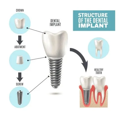 Diagram illustrating the structure of a dental implant, including the crown, abutment, and screw components, alongside a comparison of a dental implant with a healthy tooth.