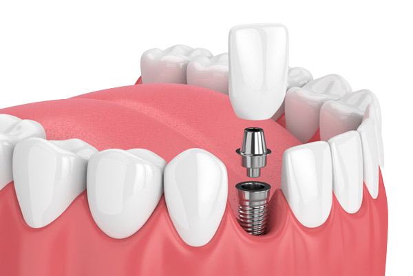 Illustration of a dental implant procedure showing a titanium implant post in the gum with a crown above it, surrounded by natural teeth.