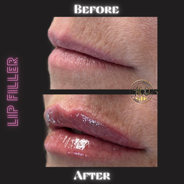 Copy of LIP FILLER.png.PNG