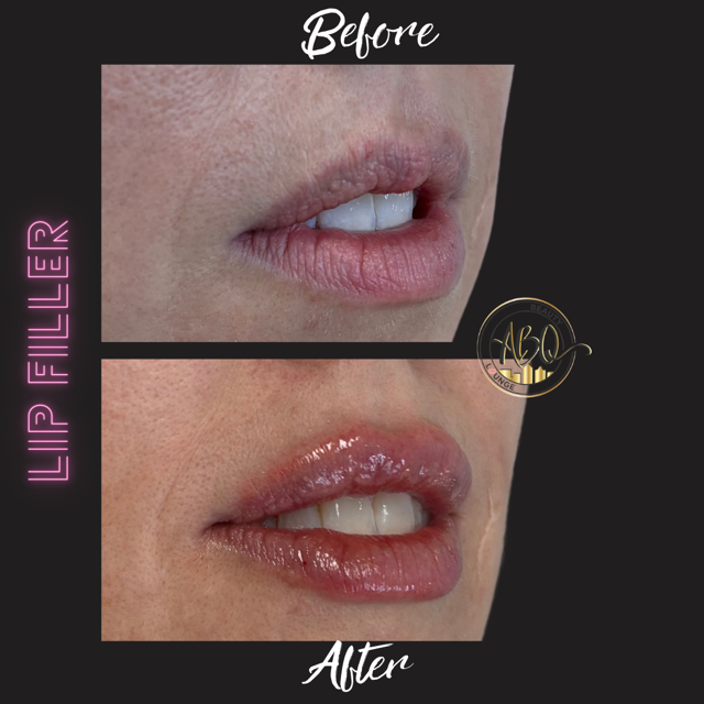 LIP FILLER.png.PNG