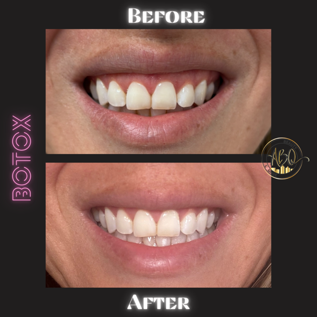 Copy of LIP FILLER.png (1).PNG