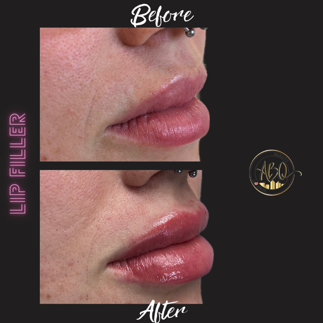 LIP FILLER.png (3).PNG