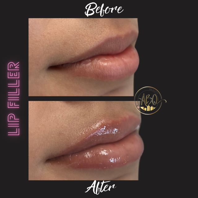 LIP FILLER.png (2).PNG