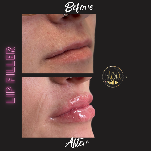 LIP FILLER.png (1).PNG