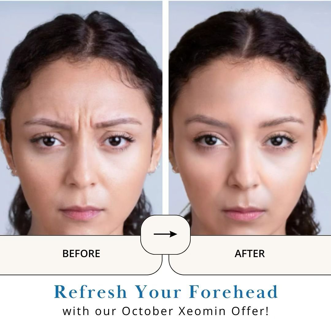 You can&rsquo;t beat this sweet Frownline fix! Deals available all month long in October: 

- 5 free units with Purchase of 20

- 10 free units with purchase of 40 units

Call us today for an appointment! 424.237.2622

#torrance #medspa #manhattanbea