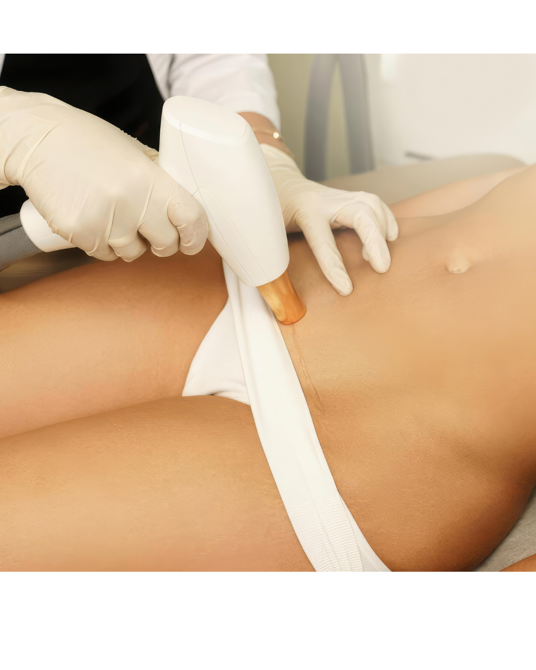 Laser Hair Removal of Medium Area-6 Treatments