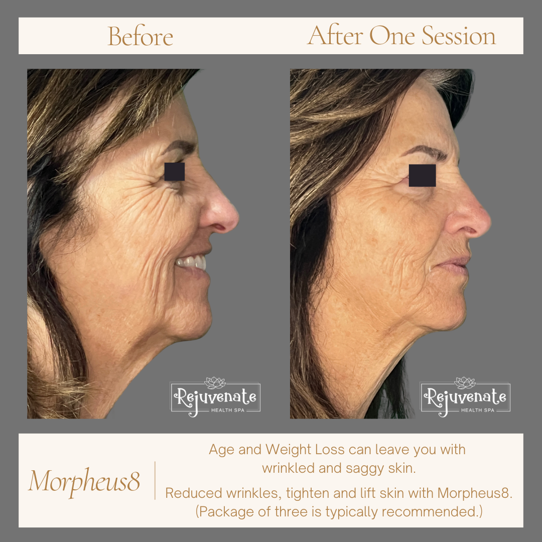 Morpheus8 Before and After Facials (2).png