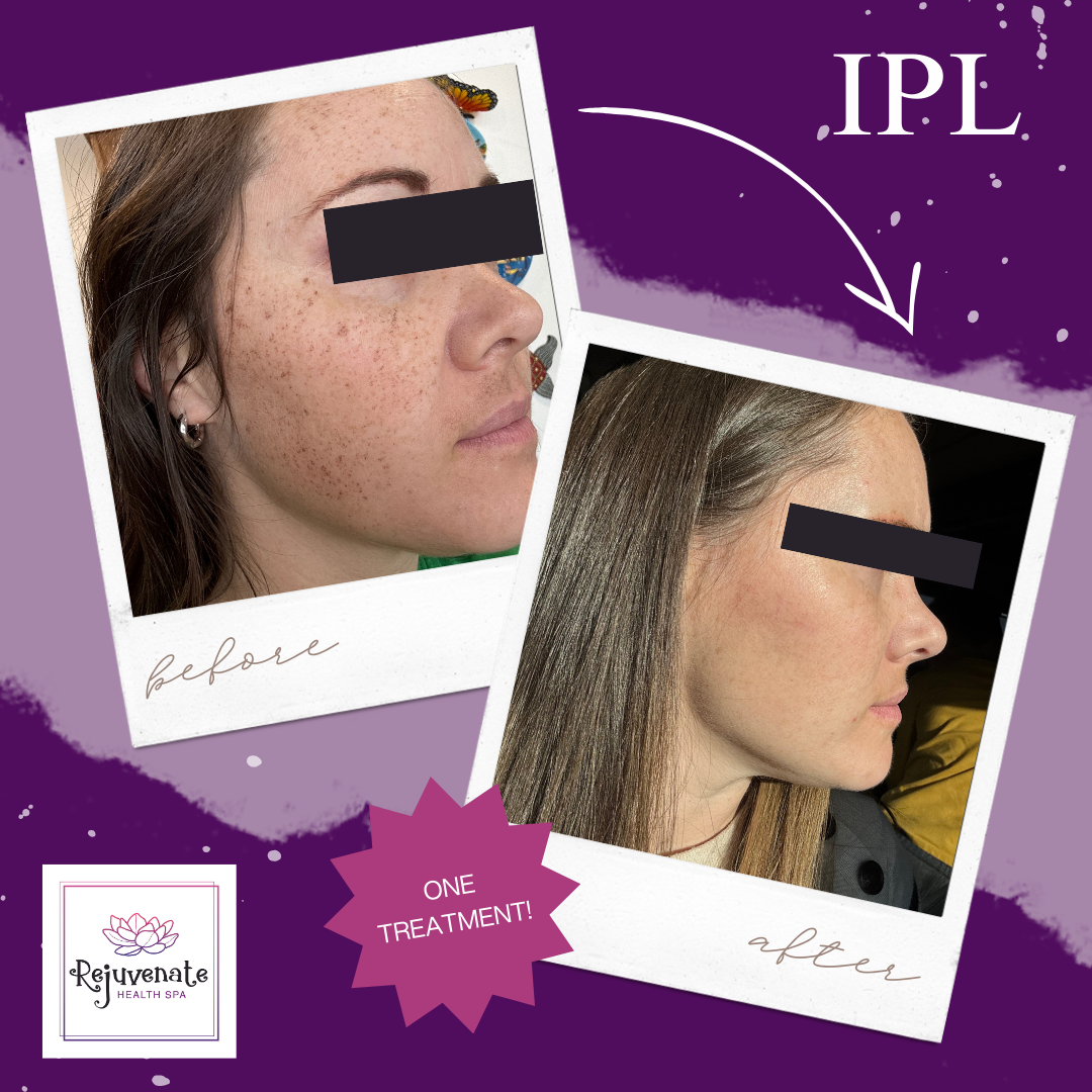 Side-by-side comparison of a woman's face before and after skincare treatment, showing improved skin texture and reduced freckles, with the background featuring IPL and Rejuvenate Health Spa branding.