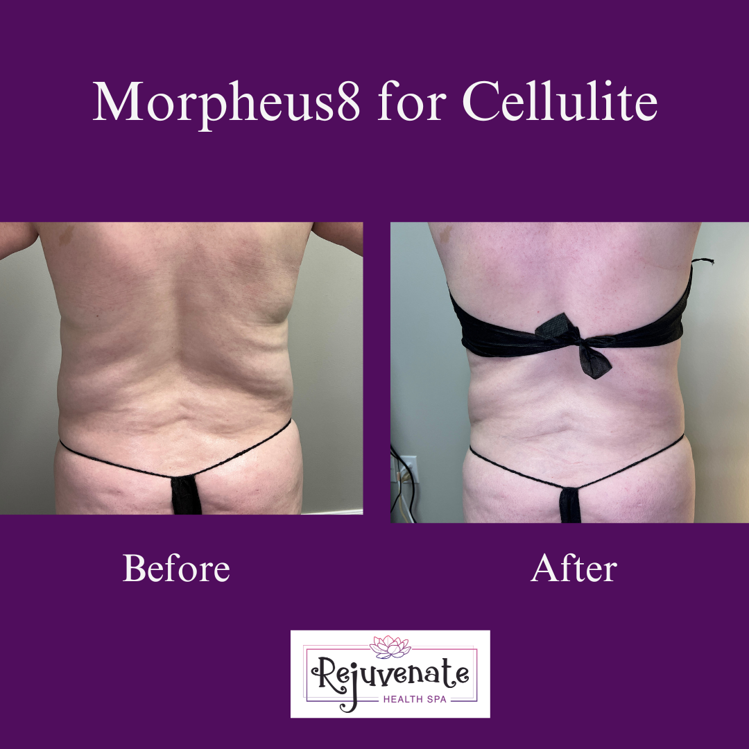 Morpheus8 treatments (10).png