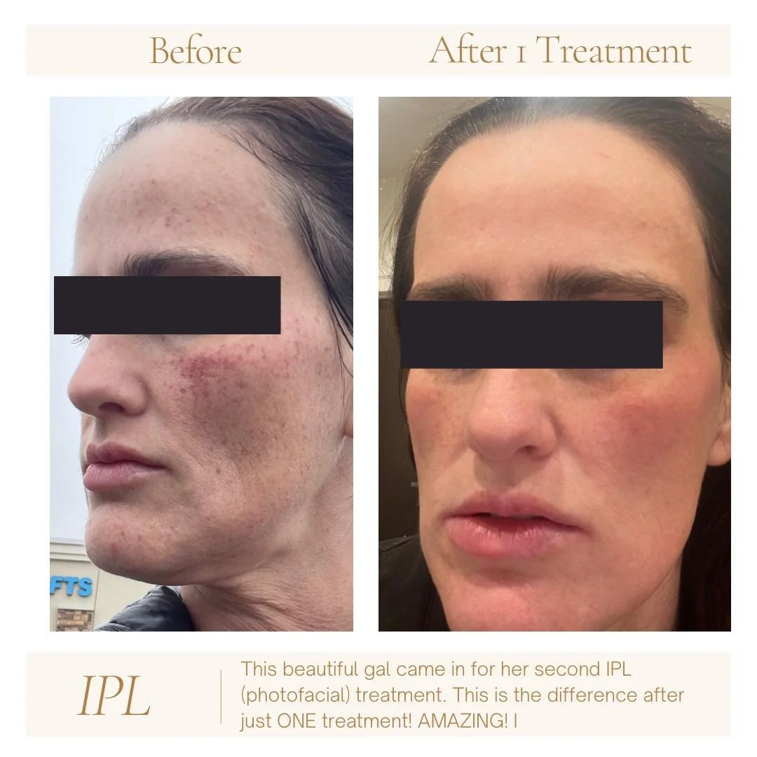 IPL example 1 treatment.jpg