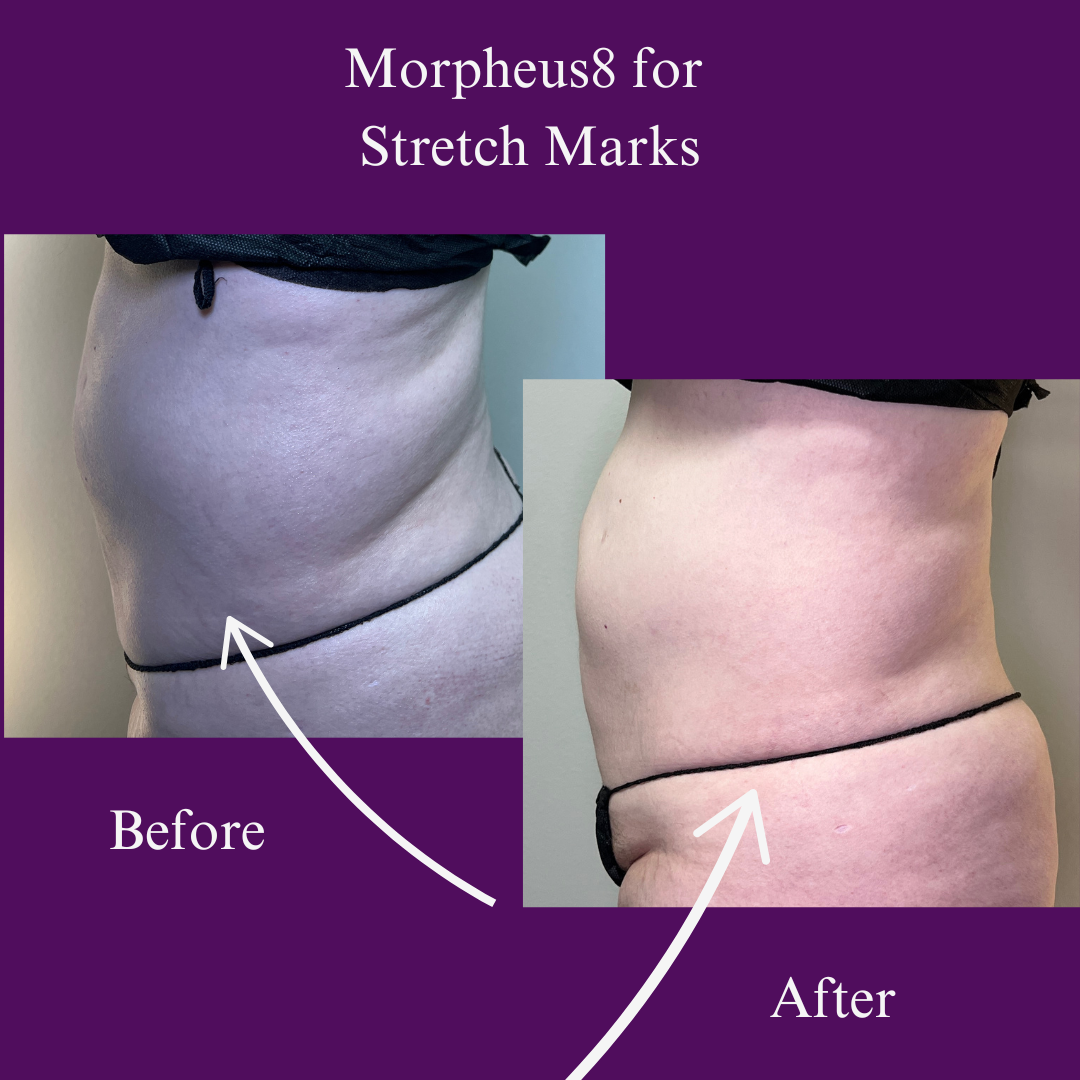 Morpheus8 treatments (11).png