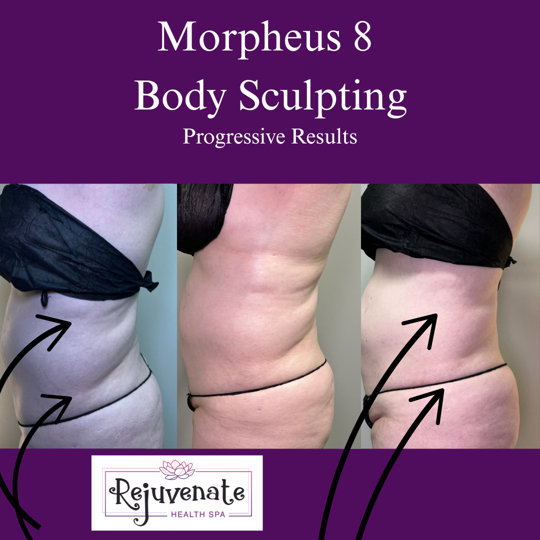 Morpheus8 treatments (12).png