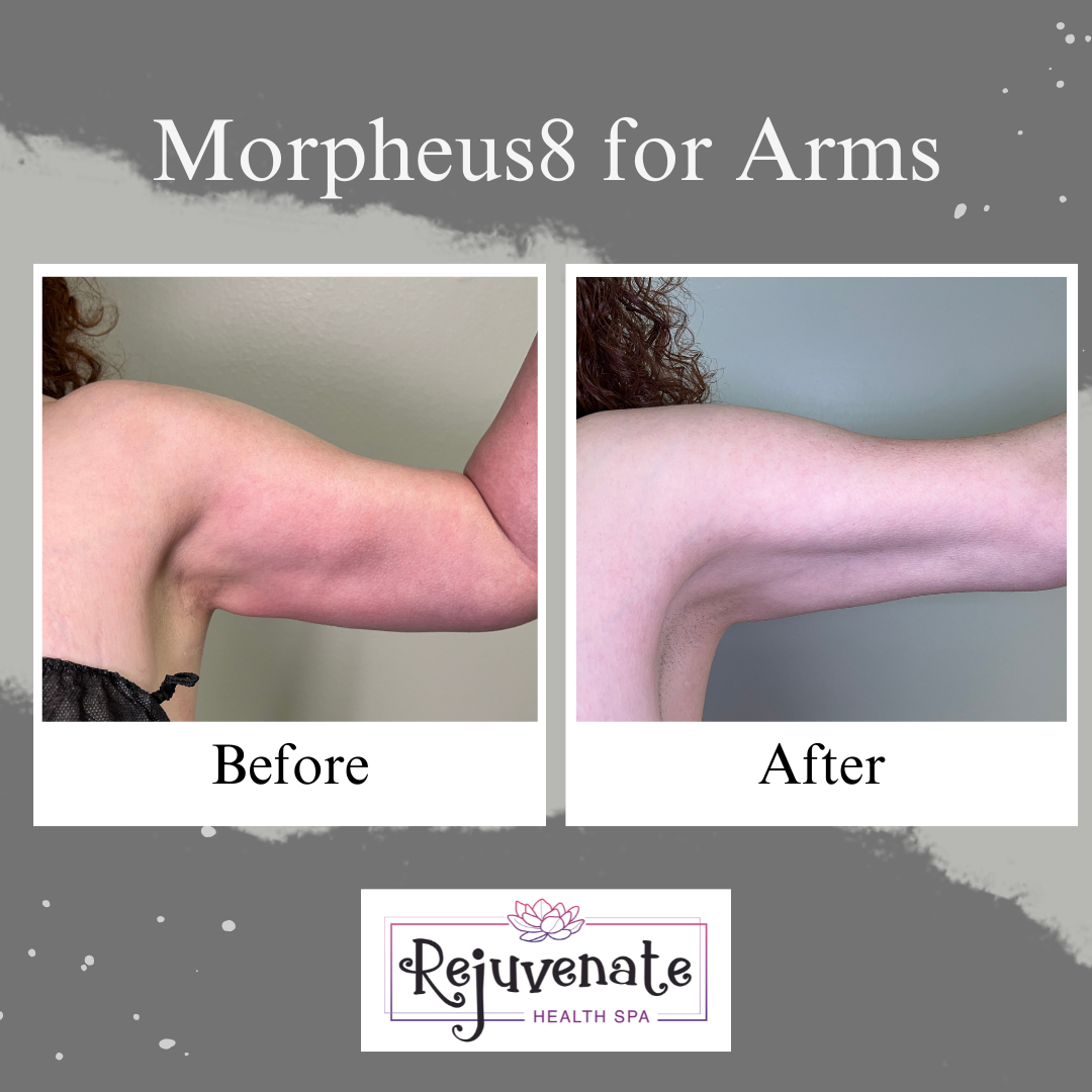 Morpheus8 treatments (9).png