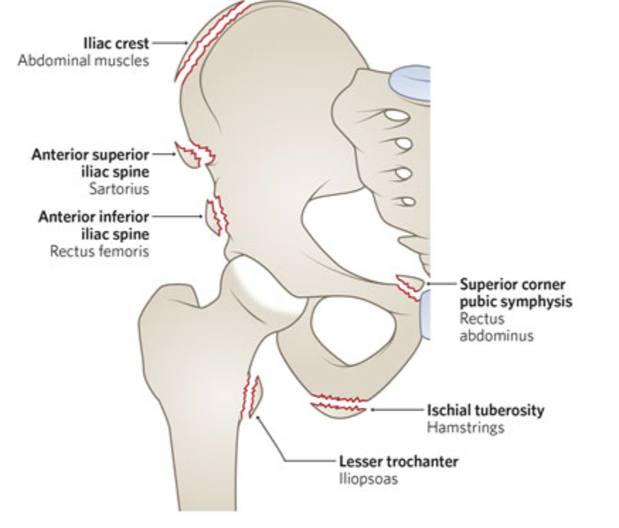 Understanding Avulsion Fractures: The Impact on Young Athletes ...