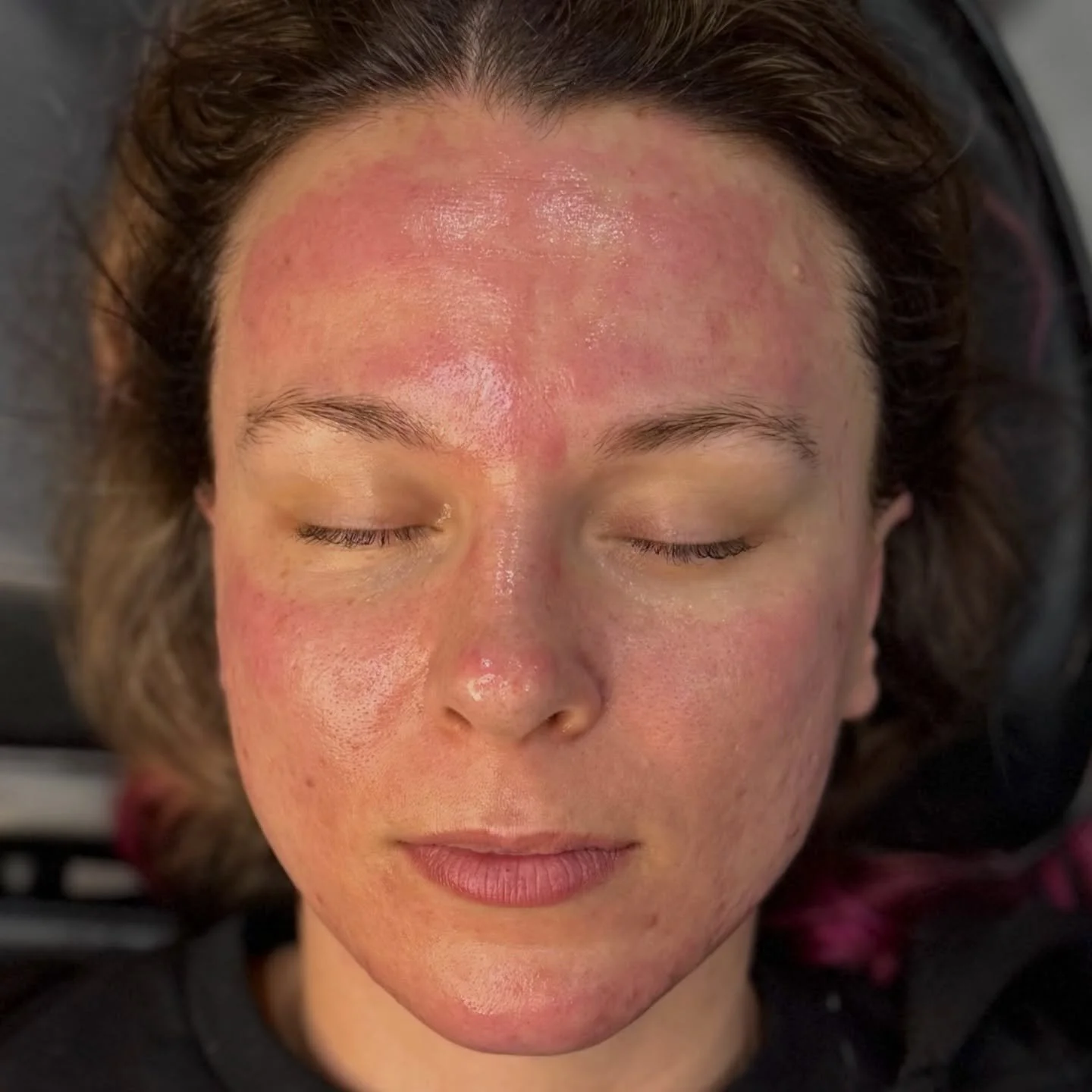 Microneedling ✨
Redness normal
No redness - also normal
It depends on your bodies inflammatory response.
Our goal is collagen stimulation to help improve skin texture, even skin tone, product absorption, soften fine lines, pore appearance, acne scars