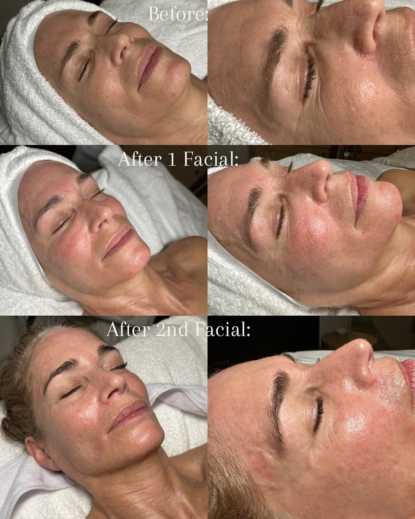 Wow!🤩 Progress results from only 2 Firming Peptide Facials!! These results are truly amazing! Don&rsquo;t miss out on the opportunity to get these incredible results for yourself.🫶
Remember to book your monthly facials!!🗓️🧖&zwj;♀️