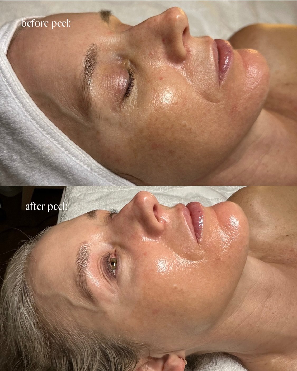 Chemical peel results!!🤩✨ 
Look at the significant reduction in hyperpigmentation, after just 1 treatment, leaving her skin GLOWING!🌟
These peels don&rsquo;t leave your face peeling for days, meaning NO downtime! 
Want your skin glowing for summer?