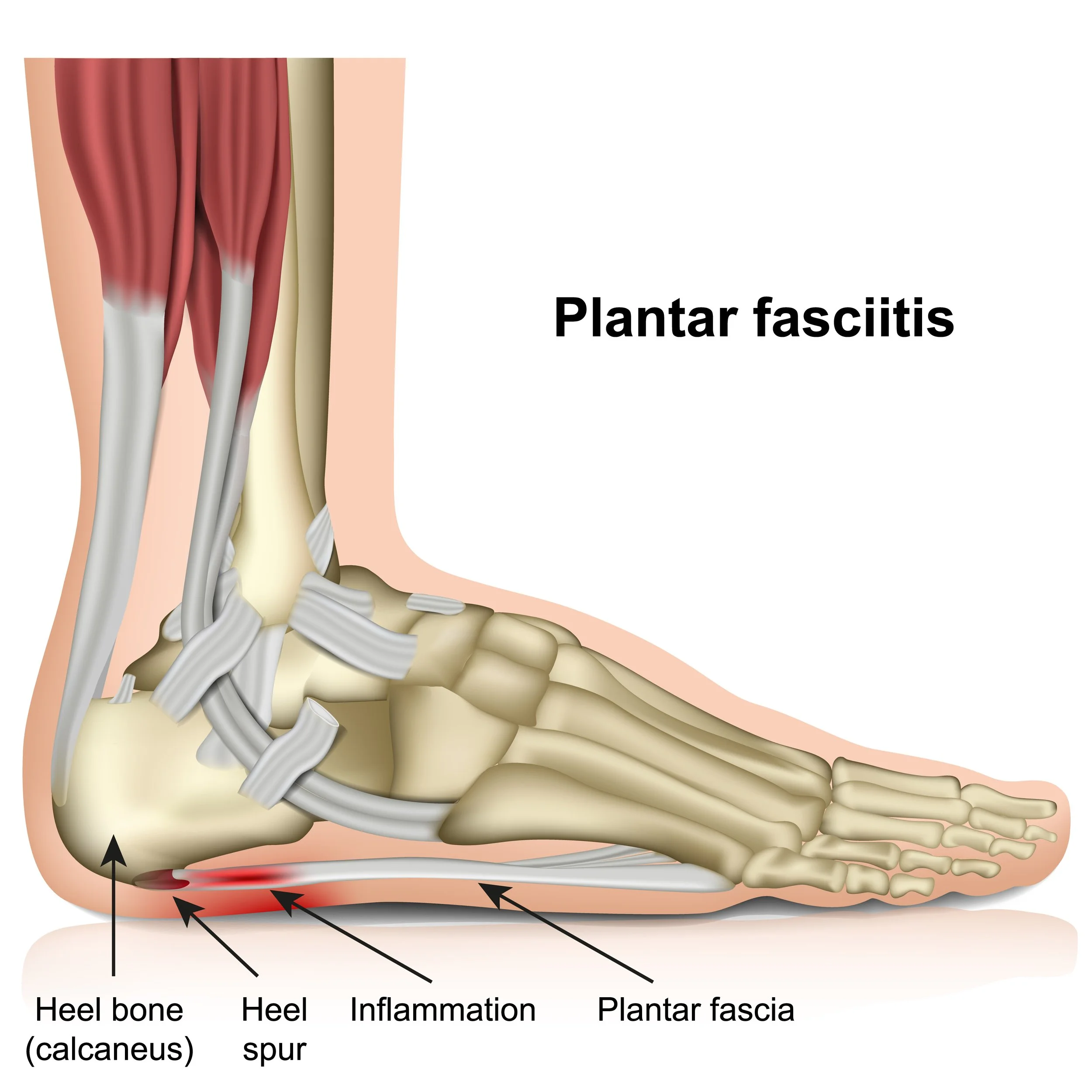 Plantar fasciitis — HealthIntell