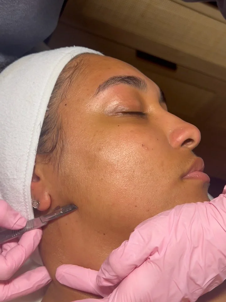 The difference a good dermaplane can make🧚🏽&zwj;♂️ 

✨brightens the overall appearance 
✨smooths the skin &amp; allows products to penetrate more efficiently
✨not only removes peach fuzz, but old, dead dry skin!

100/10 recommend🤪