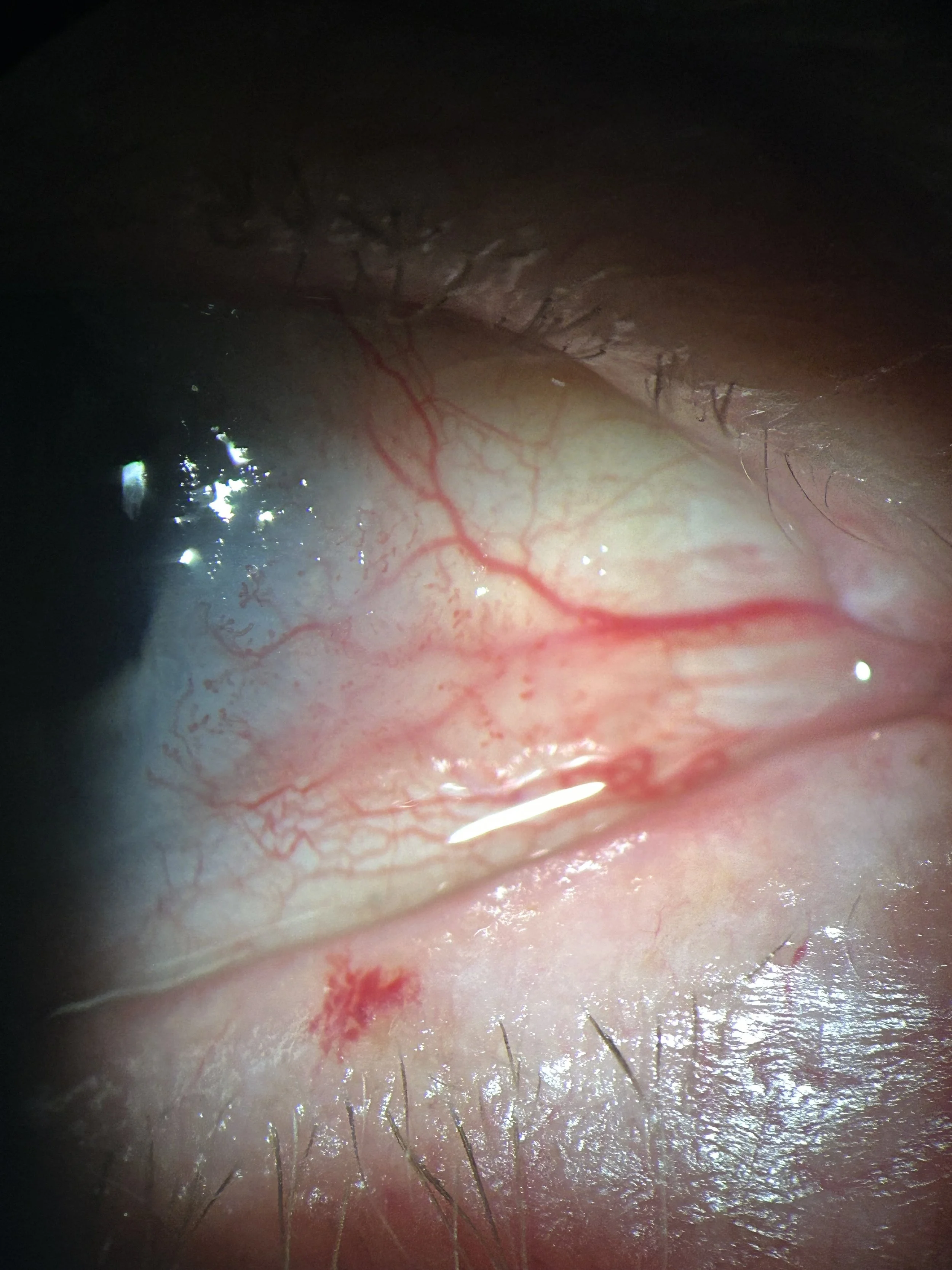Conjunctival surface neoplasm.jpg