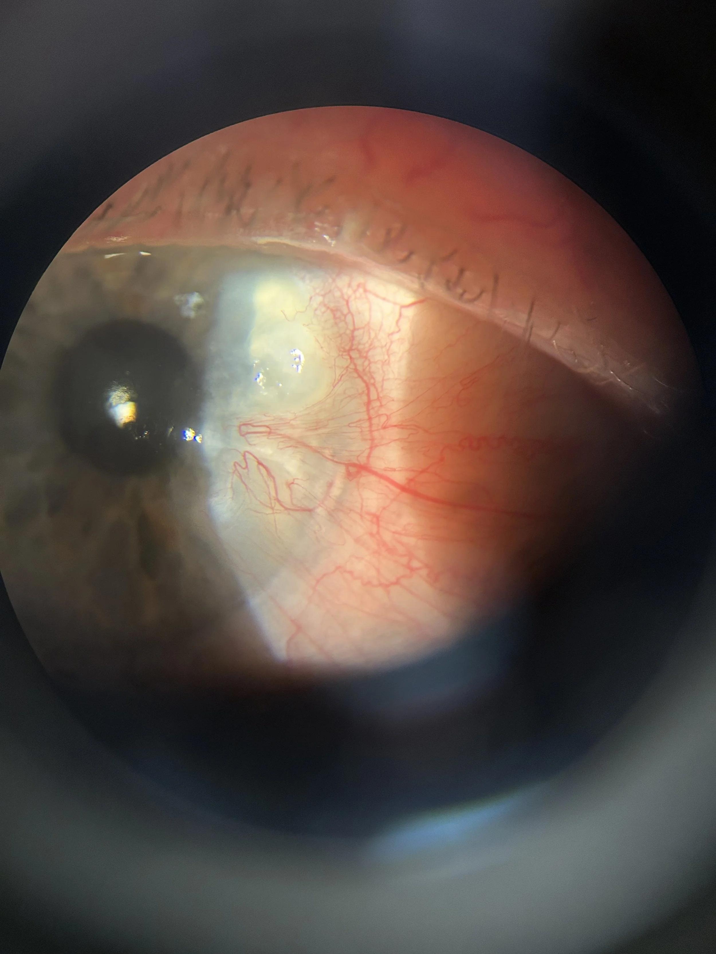 pterygium.jpg