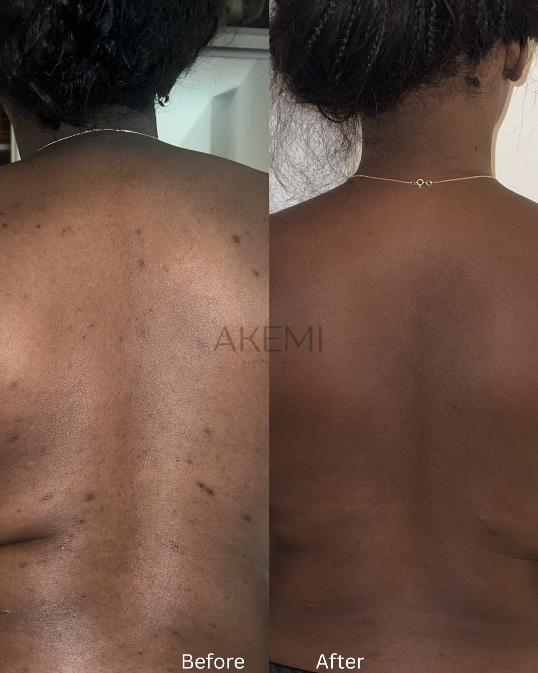 A Back Acne Transformation