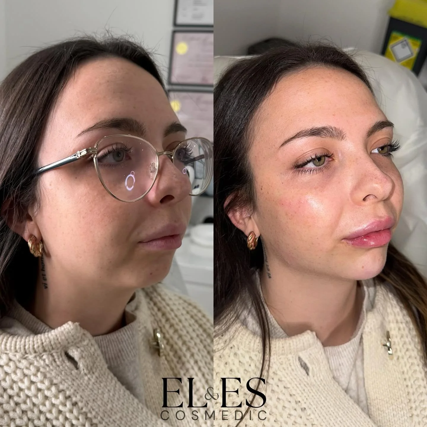 Beautiful face transformation 😍

Areas treated - cheeks, jaw, chin and lips 💉

📲 DM to book in for our Halloween offer now!

#facialfiller #facialfillerskent #lipfiller #chinfiller #cheekfiller #jawfiller #aestheticskent