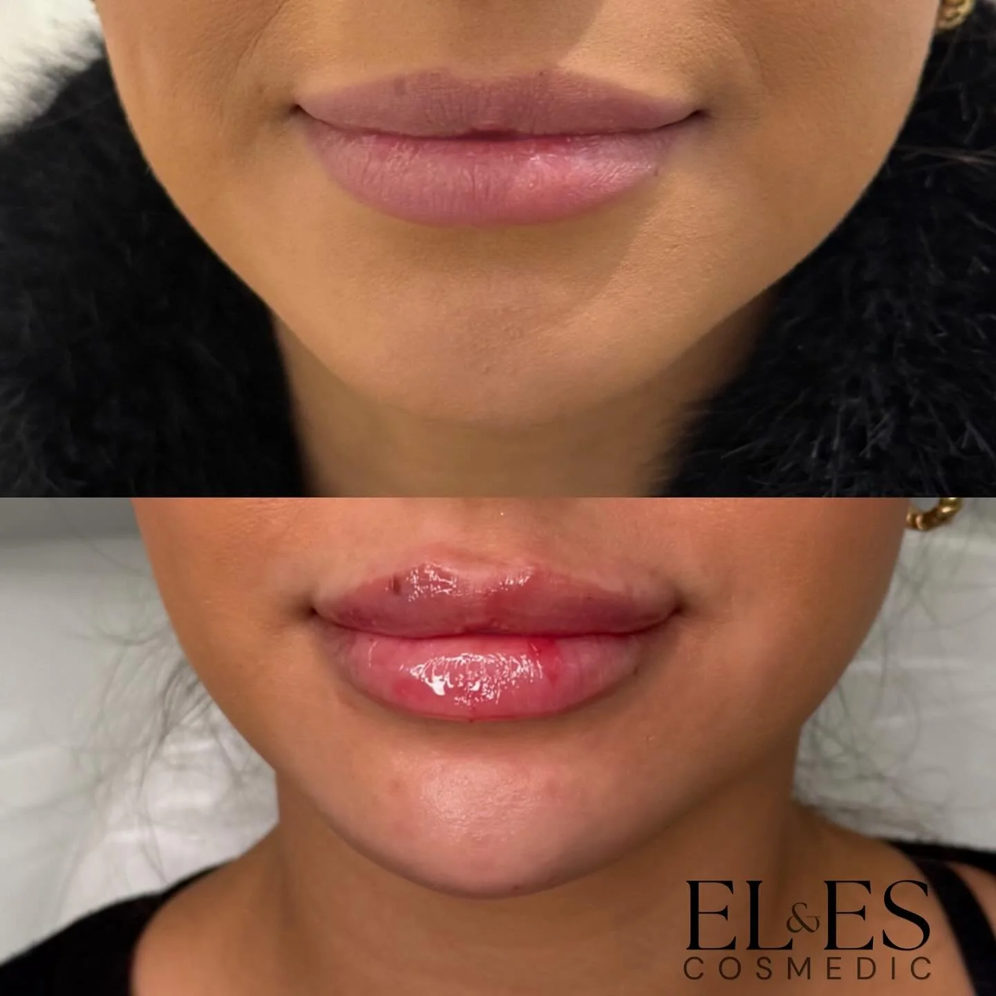 ✨ Beautiful balance and definition ✨

This stunning result was achieved with lip and chin enhancement, enhancing natural harmony and contour 💋

🎃 Don&rsquo;t miss our Halloween Offer &mdash;
1ml for &pound;150 or 2ml for &pound;300 👻
The perfect t