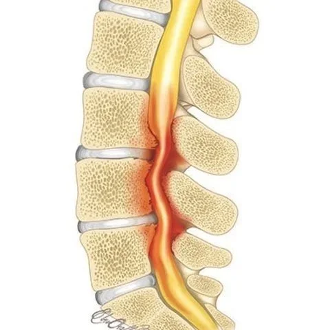 A cross-section of a lumbar spine showing the narrowing of the spinal canal, which is putting pressure on the spinal cord.