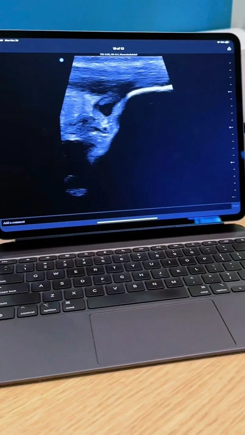 Diagnostic Ultrasound Achilles Tendonitis