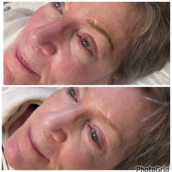 Example of nanoblading combo over scarred brows