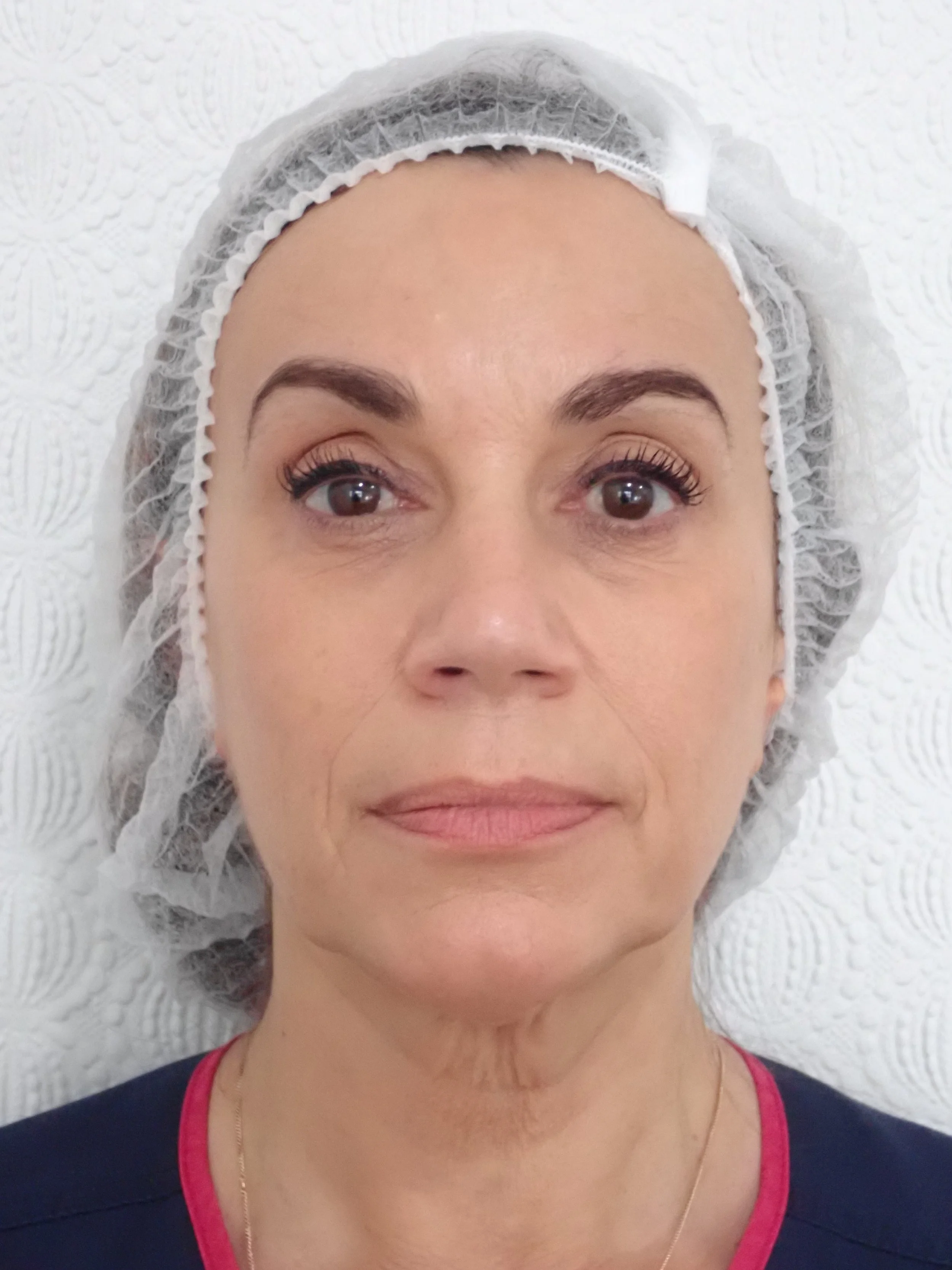 Skin Needling — Skindeep Clinic