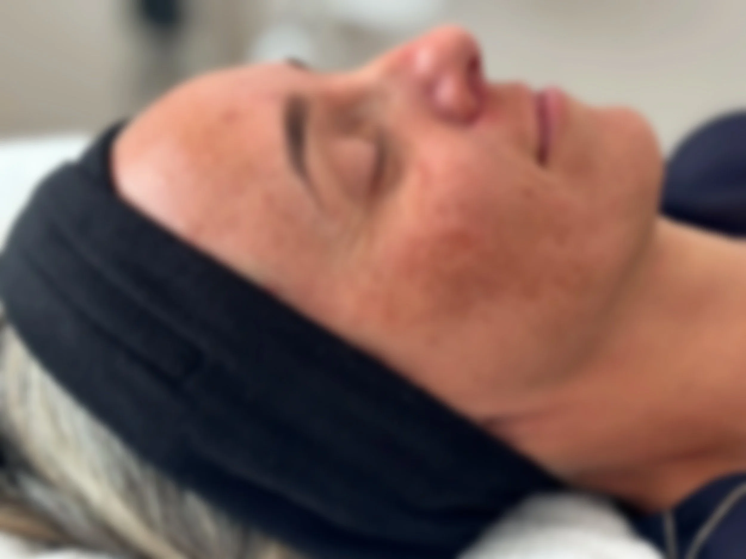 Let’s talk Melasma