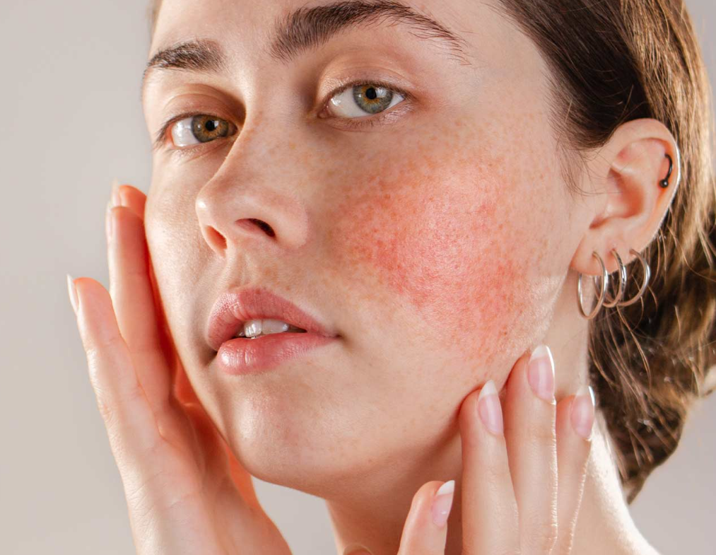 Unmasking the Truth: Understanding Rosacea.