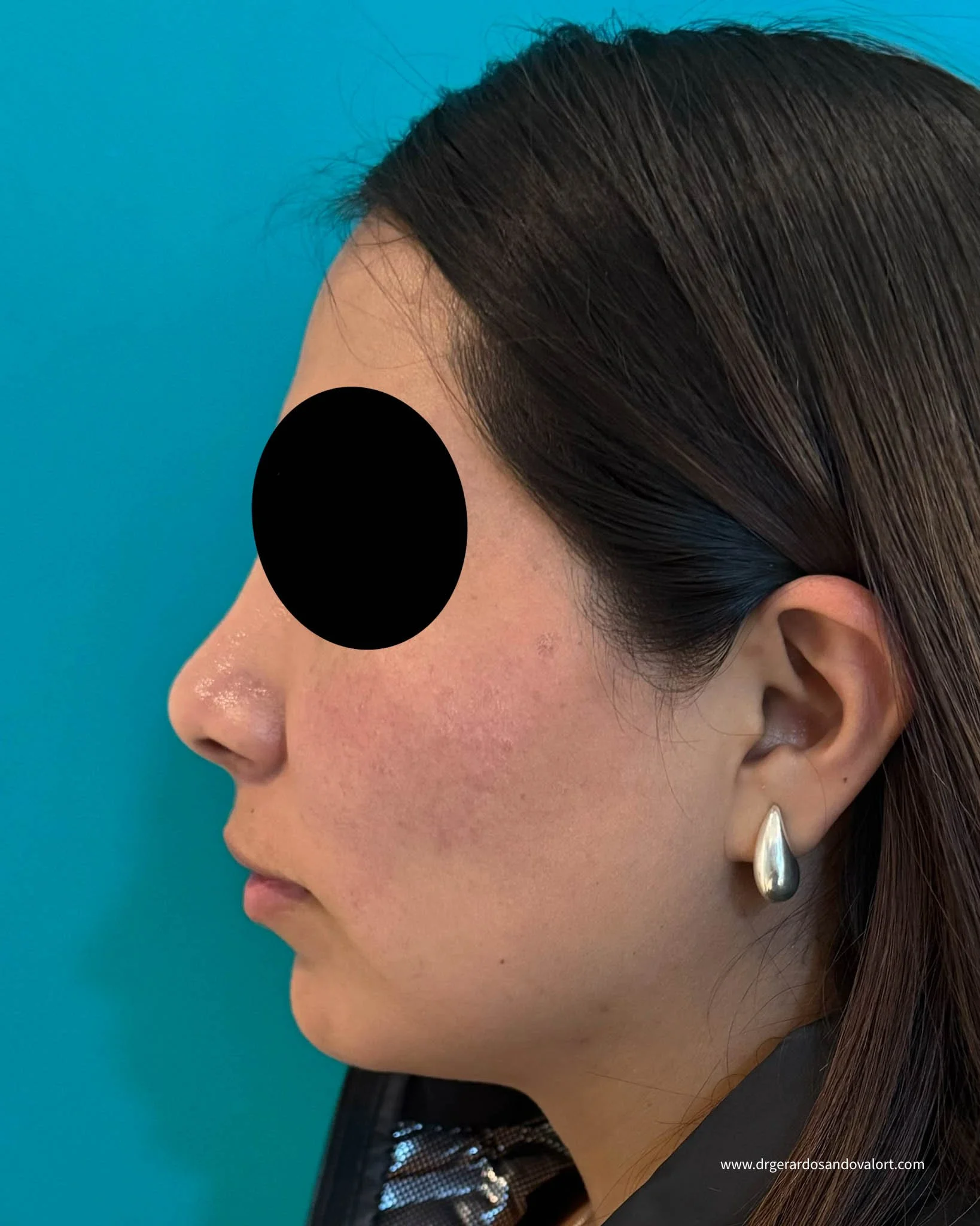 Imagen de perfil a 90 grados para evaluación de rinoplastia, mostrando detalles de la nariz y el contorno facial para un diagnóstico preciso